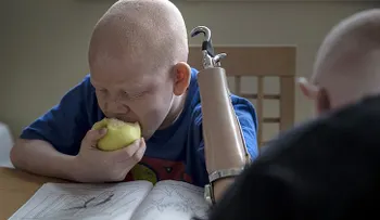 Las escalofriantes historias de los albinos en Tanzania (VIDEO)