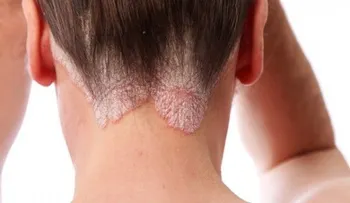 El Tratamiento Psoriasis debe ser para toda la vida