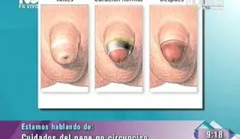 Cuidado del Pene No Circunciso (VIDEO)