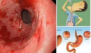Este poderoso remedio cura la gastritis y la acidez para toda la VIDA 