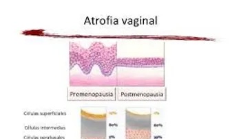 La atrofia vaginal provoca sequedad e inflamación: Causas y síntomas