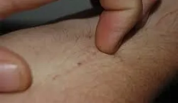 Si sientes picazón en la piel (prurito), estas pueden ser las causas: