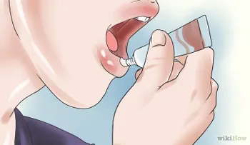 Las llagas de tu boca, quítala en 2 minutos 