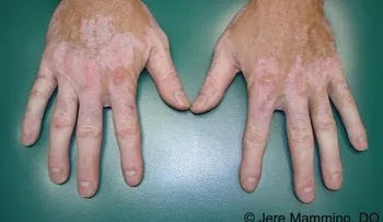 Efectivos remedios para manchas blancas en la piel (vitiligo)