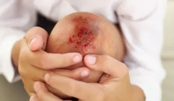 Hemofilia: Prevenir sangrado espontáneo desde la infancia evita el deterioro