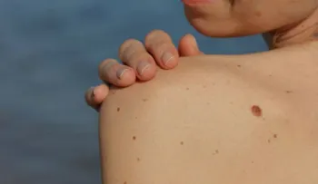Los lunares y las pecas; datos que seguramente no conocías