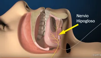 ¿Roncas mucho? Quizá sufres apnea del sueño
