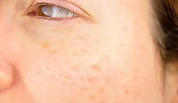 Seis tipos de manchas en la piel: ¿qué significan y cómo tratarlas?