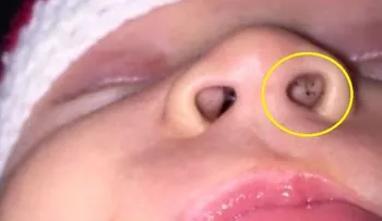 Una madre notó puntos negros en la nariz de su bebé.....cuidado con esto !!