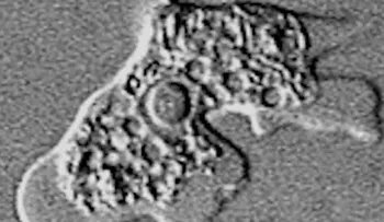 Paciente con el cuarto caso de ameba comecerebros; de este año está recibiendo tratamiento