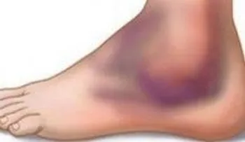 Los esguinces de tobillo y como tratarlos de forma natural