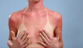 Quemaduras de sol provocan aparición de melanoma