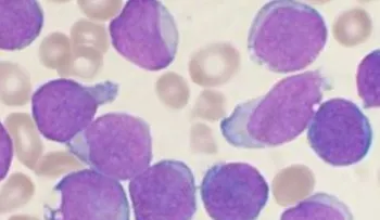 Científicos afirman que la leucemia puede devorarse