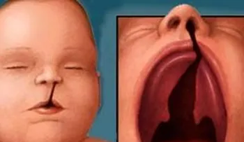 Reacción de esta pequeña tras ser operada de su labio leporino (Video)