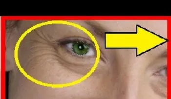 La forma de eliminar arrugas de los ojos