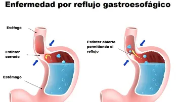 Lo que no sabes sobre la acidez estomacal