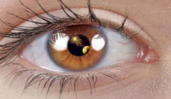 Ojeras: Qué las causa y cómo eliminarlas
