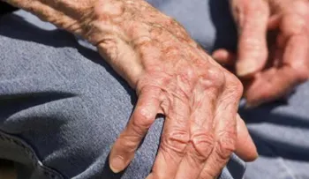 ¿Cómo vivir con Artritis Reumatoide?