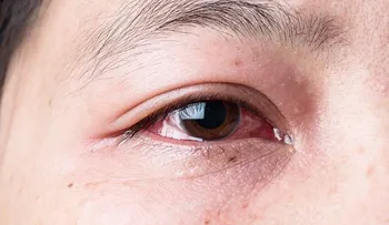 6 efectivos remedios para la conjuntivitis
