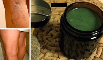  Mujer curó sus varices con esta antigua receta de la abuelita. Resultados casi inmediatos!