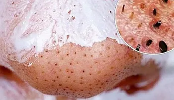 Todos tus puntos negros salen de de tu rostro en solo minutosâ?¦ Wao!!!