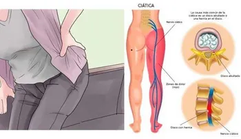 Nervio ciático: 2 simples ejercicios para recuperar la movilidad de inmediato?!