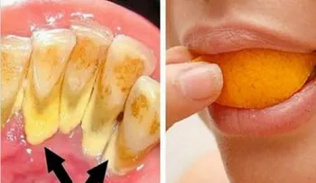 Elimina el sarro y blanquea tus dientes en 15 min con esta receta
