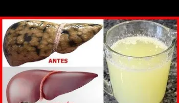Cinco alimentos para curar para siempre el Hi­gado Graso y dejarlo como nuevo