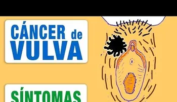 Aprende las señales para detectar un cáncer de vulva, sin tener que ir a un médico