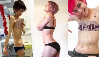 Una joven muestra en fotos cómo se recupera de la anorexia: "Se puede volver a ser feliz"