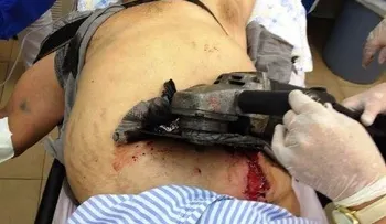 Hombre se corta la barriga con una sierra