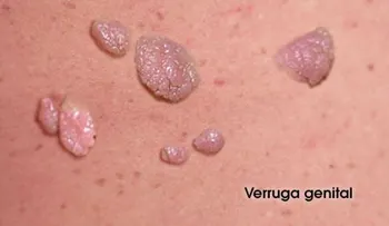 Tratamientos para las verrugas genitales