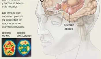 Fisioterapia en la enfermedad de Alzheimer