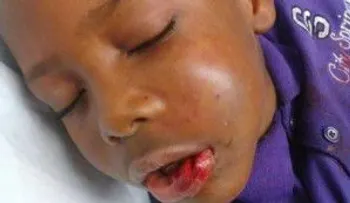 Acusan a tutor de abuso infantil contra un niño con fractura de mandíbula