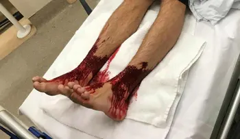 ¿Podrían ser las pulgas marinas responsables de estas picaduras?