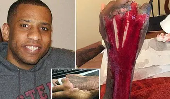 (FOTO FUERTE): Un hombre estuvo a punto de ser devorado vivo por su costumbre de crujir los nudillos