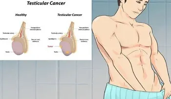 5 signos de cáncer testicular que la mayoría de hombres les da vergüenza hablar