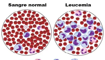 6 signos de leucemia que toda mujer debe saber