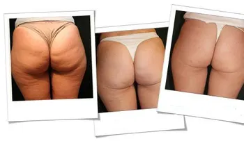 Cómo evitar la celulitis en las piernas