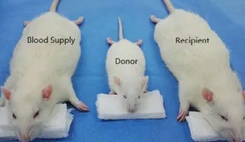 El polémico experimento del médico que quiere realizar el primer trasplante de cabeza entre seres humanos