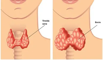 5 hábitos que alteran tu tiroides
