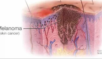 ¿Tiene estos factores de riesgo para melanoma?