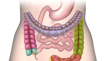 5 señales de que tienes un intestino perforado