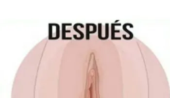 Este es el remedio más eficaz que una cirugía para estrechar la vagina