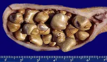 Misterio chino revelado. Esto termina con todas las piedras de la vesícula en sólo 1 semana