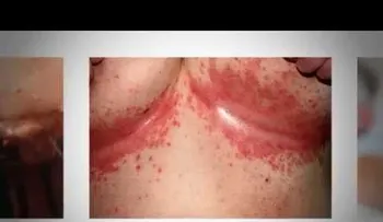 Qué son las ladillas? ¿Cuáles son los síntomas y tratamiento?