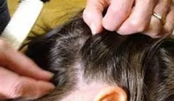 Sácale los piojos de manera efectiva y natural con estos tres remedios 