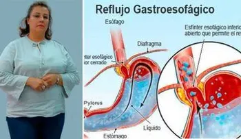 Sufría de reflujo causado por la obesidad y los medicamentos, pero con esto pude eliminarlo