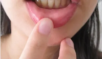 Aftas en la boca pueden ser señales de Enfermedad de Crohn