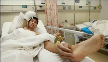 Tuvieron que implantarle la mano en la pierna para seguir con vida 